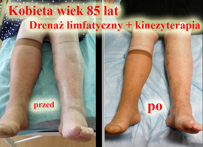 drenaż limfatyczny